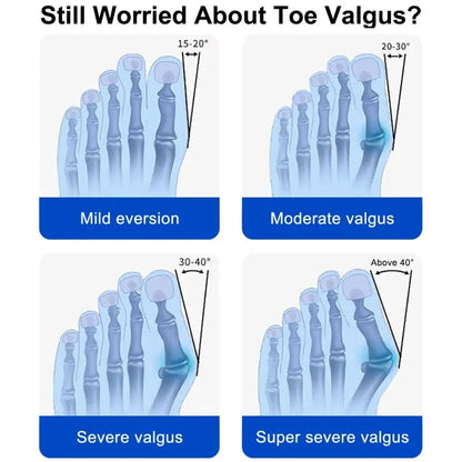 🔥 LAST SALE TO 62% OFF FOOT 👣 Bunion Fix