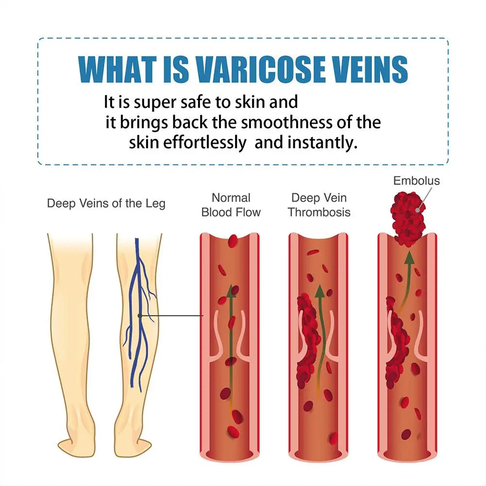 Varicose Veins Cream